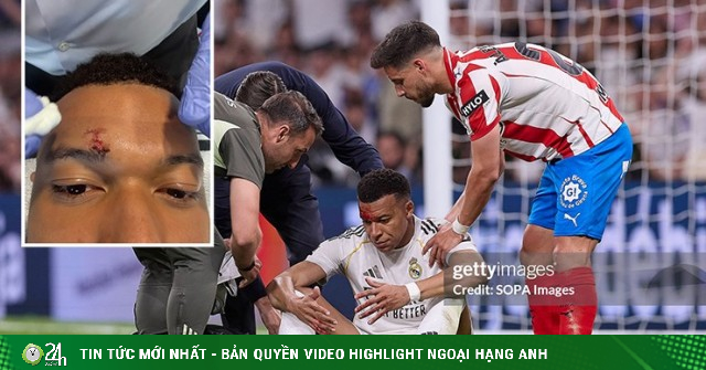 Mbappe khâu 3 mũi, vắng mặt buổi tập của Real: Có lỡ đại chiến Bayern?