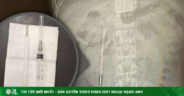 Nuốt nhiệt kế từ năm 12 tuổi, đau bụng mới biết dị vật vẫn còn nguyên sau 20 năm