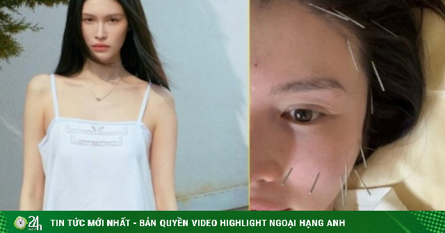 Bạn gái Trần Vỹ Đình châm cứu để nâng cơ, ngừa chảy xệ da