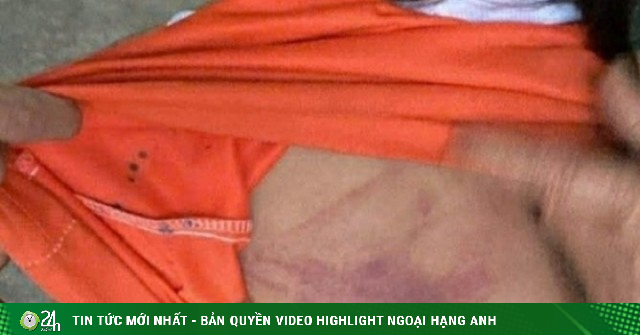 Bé gái lớp 2 bị bạn dùng thước đánh bầm tím người