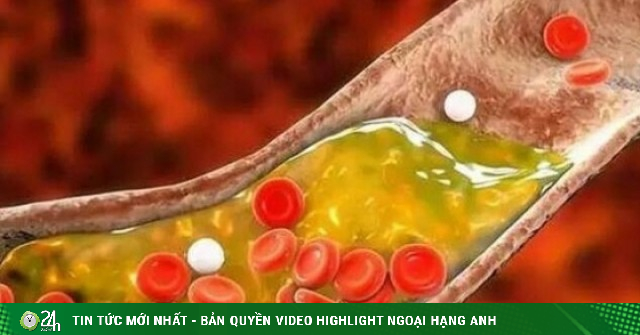 Xơ vữa động mạch diễn ra thế nào, làm sao để đảo ngược?