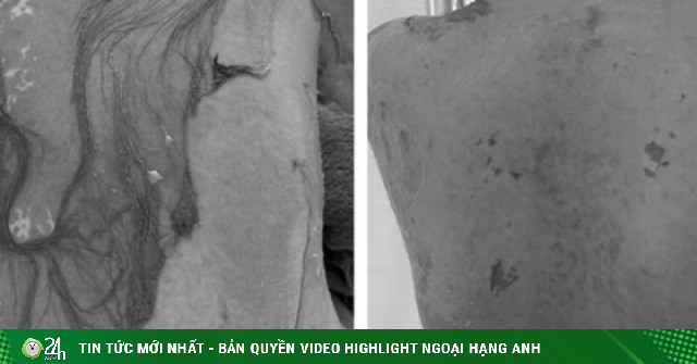 Người phụ nữ 35 tuổi bị tróc da toàn thân thừa nhận 1 sai lầm nhiều người Việt mắc phải