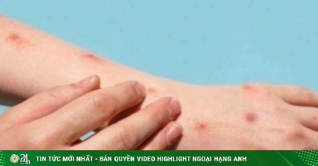 Thủy đậu tăng nhanh khi giao mùa: Làm gì để phòng bệnh hiệu quả?