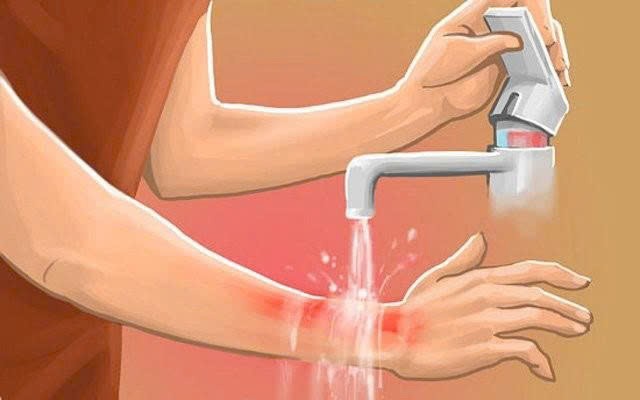 Bỏng nước sôi là tai nạn sinh hoạt thường gặp, có thể gây tổn thương da từ nhẹ đến nặng nếu xử trí sai