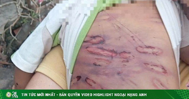 Bé 2 tuổi bị bạo hành đã qua nguy kịch, sức khỏe dần ổn định