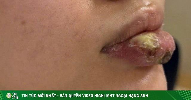 Hoại tử môi sau khi tiêm 'giải filler' ở spa không phép