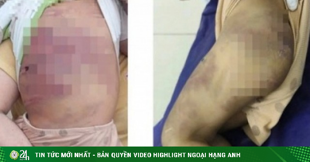 Diễn biến mới nhất vụ bé trai 2 tuổi bị bạo hành ở TPHCM