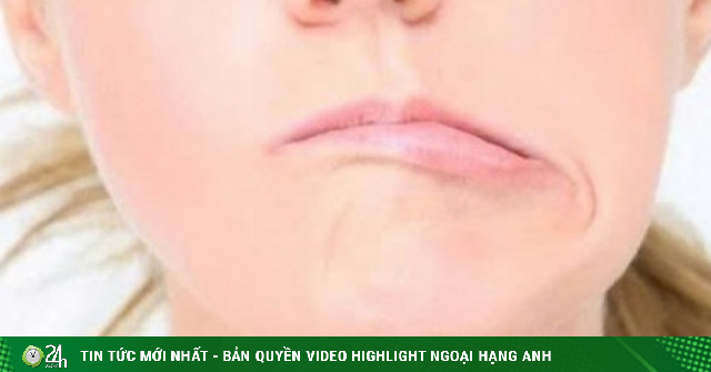 Méo miệng, lệch mặt giữa mùa hè: Nguyên nhân ít ai ngờ tới