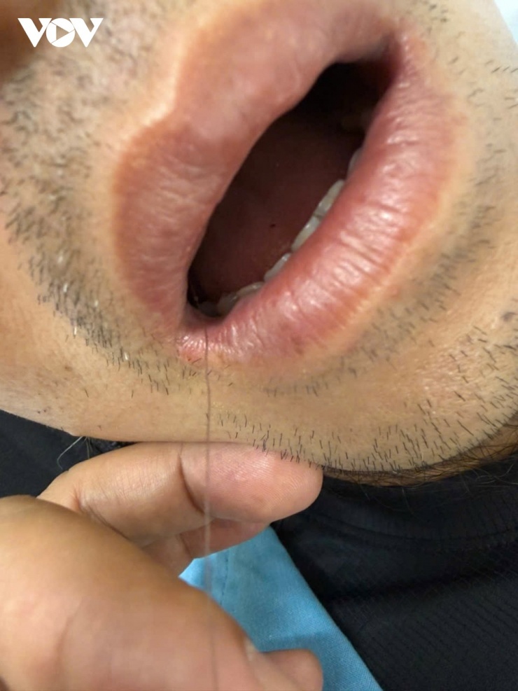 Bệnh nhân khi nhập viện còn nguyên dây câu gắn với lưỡi câu từ miệng