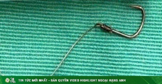 Hy hữu: Nhập viện cấp cứu vì lưỡi câu nằm ngang thực quản sau khi ăn cá