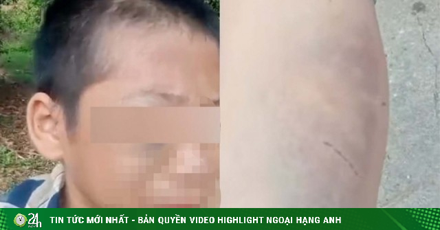 Cháu bé bầm tím khắp người ở Nghệ An: Công an vào cuộc xác minh