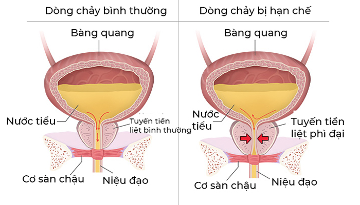 Nam giới trung niên, cao tuổi cần đặc biệt chú ý những biểu hiện bất thường này kẻo suy thận như chơi! - 1