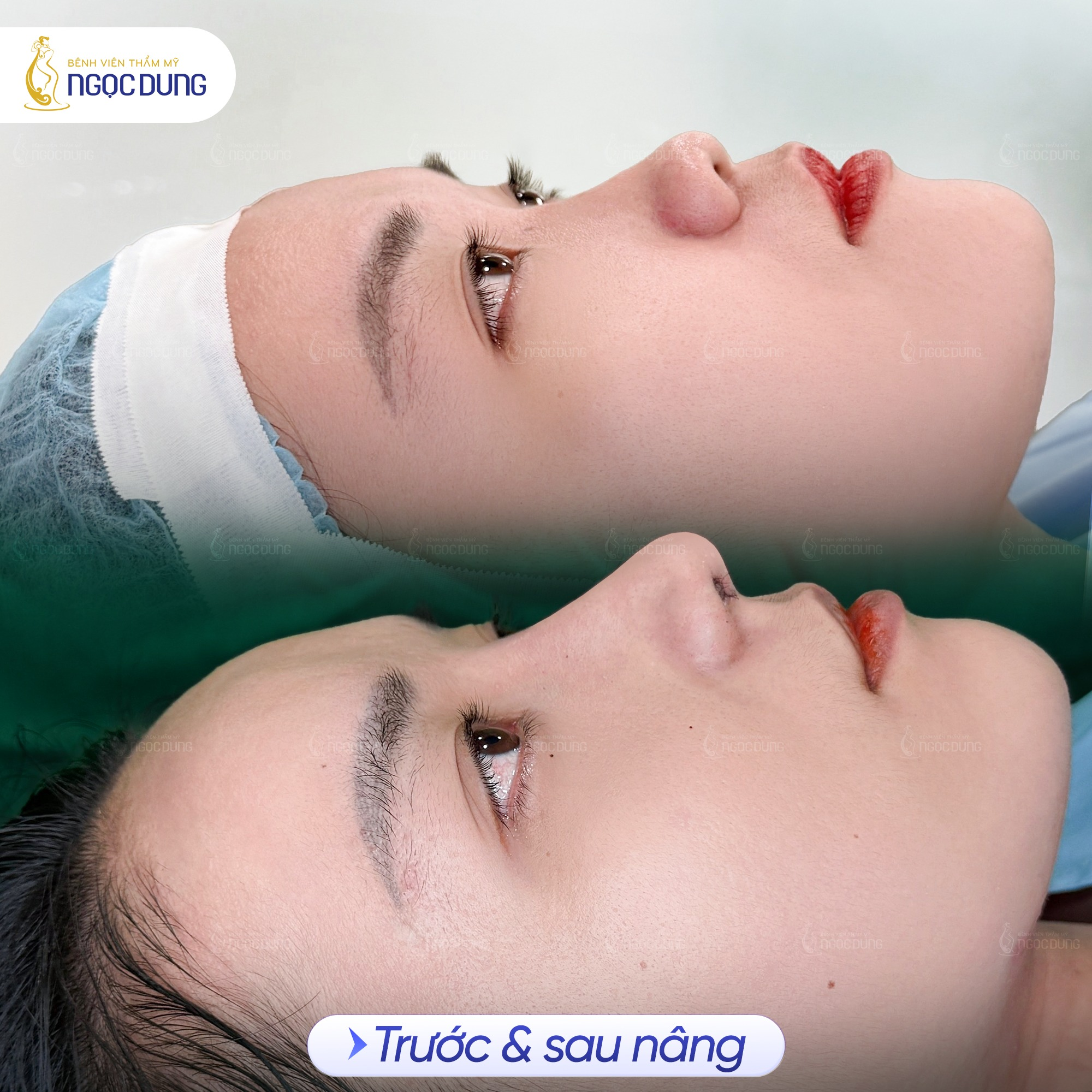 Sự thay đổi ấn tượng cấu trúc mũi của khách hàng của khách hàng sau khi nâng mũi tại Bệnh viện Ngọc Dung