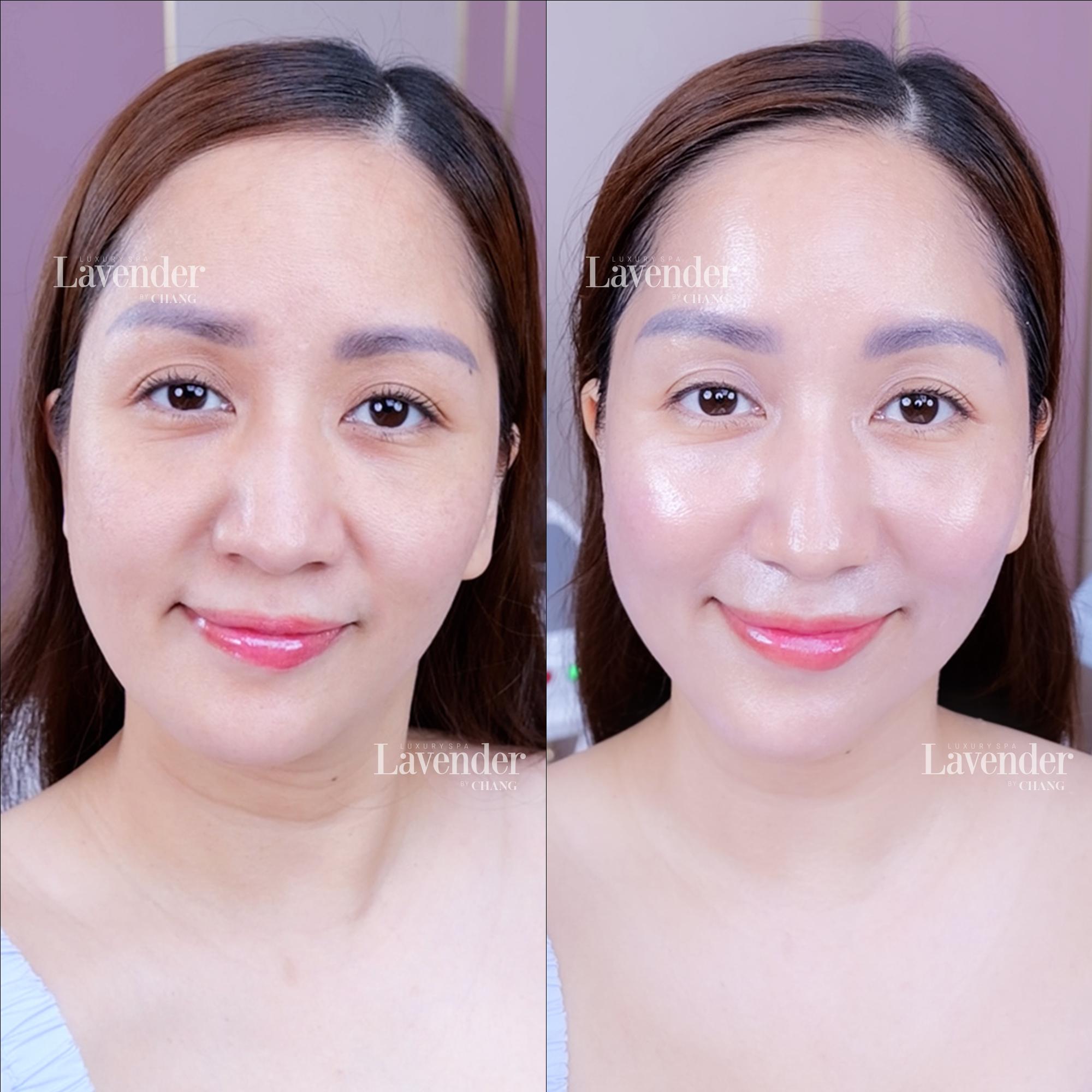 Làn da mẹ bỉm 3 con Khánh Thi cải thiện rõ rệt sau liệu trình xóa nám trẻ hóa da Nanocell Diamond