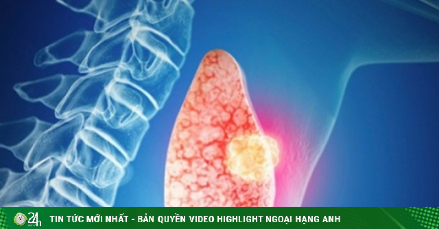 Phát hiện ung thư tuyến giáp ở tuổi 33, cô gái may mắn vì làm điều nhiều người Việt chủ quan