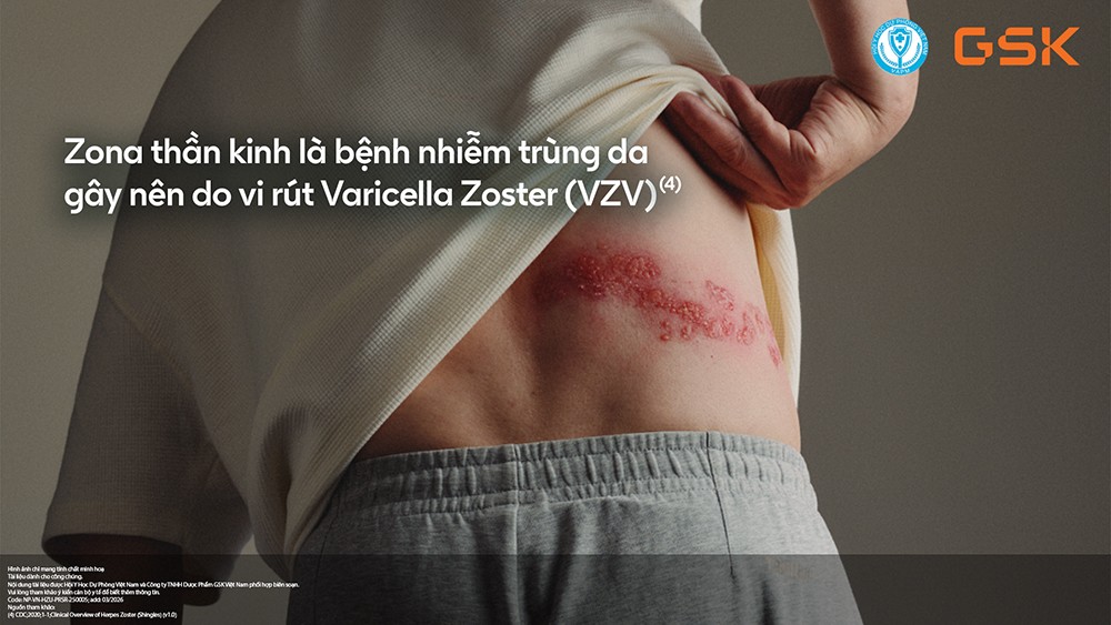 Zona thần kinh là bệnh nhiễm trùng da gây nên do vi rút Varicella Zoster (VZV) (4).