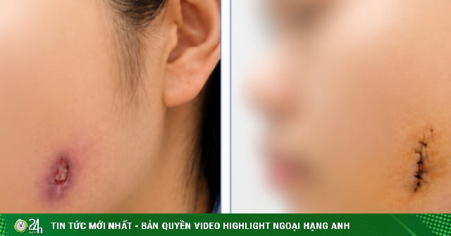 Thủng mặt vì đau răng khôn lâu ngày không điều trị