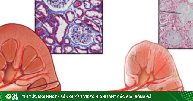 Cô gái 20 tuổi suy thận giai đoạn cuối vì chủ quan với dấu hiệu xuất hiện mỗi sáng
