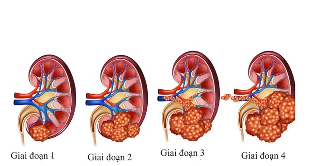 Ung thư thận là một trong những loại bệnh người Việt mắc nhiều mỗi năm.