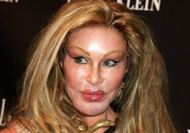 Jocelyn Wildenstein khiến người khác kinh sợ với khuôn mặt sưng vù. Đây cũng là hậu quả của việc nghiện phẫu thuật thẩm mỹ của cô. Trong những năm qua, Jocelyn đã phải chi ra hơn 3 triệu USD &#40;hơn 60 tỷ đồng&#41; cho quá trình làm đẹp chỉ gánh về một gương mặt “quái nhân”.