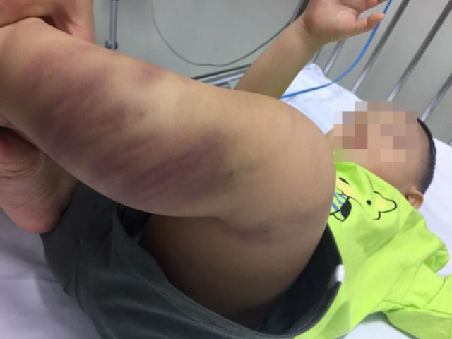 Bé trai hơn 1 tuổi bị đánh đập bầm tím, tổn thương bộ phận sinh dục?