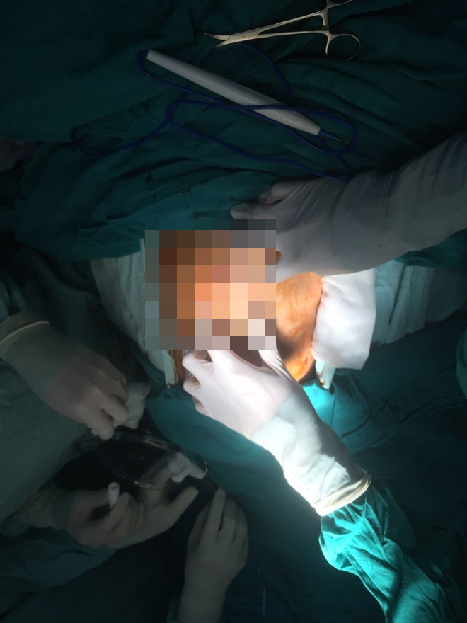 Chờ mổ gãy xương đùi, nam bệnh nhân tự đâm nhiều nhát vào ngực - 1