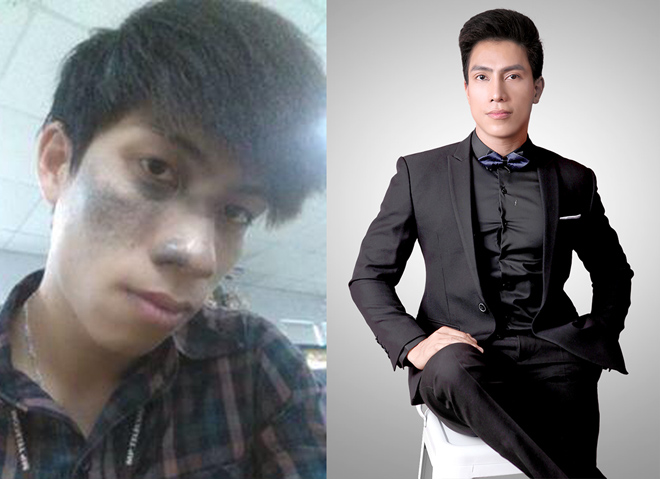 Đổi dáng mũi thanh tú, chàng “hai lúa” hóa hotboy “lai tây” tại The Face 2018 - 1