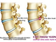 Phát hiện mới giúp giảm đau lưng và cải thiện tình trạng thoát vị đĩa đệm