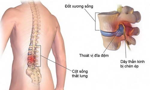 Thoát vị đĩa đệm và các quan niệm sai lầm - 2