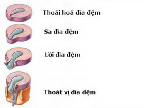 Thoát vị đĩa đệm và các quan niệm sai lầm - 1