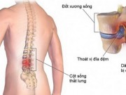 Sức khỏe đời sống - Thoát vị đĩa đệm và các quan niệm sai lầm