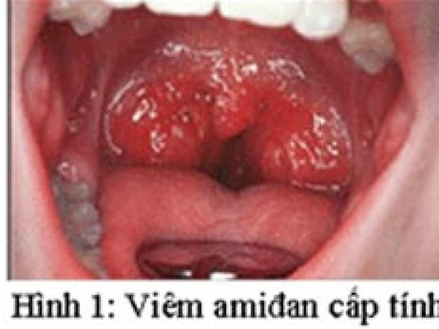 Bài thuốc chữa viêm amidan mạn tính