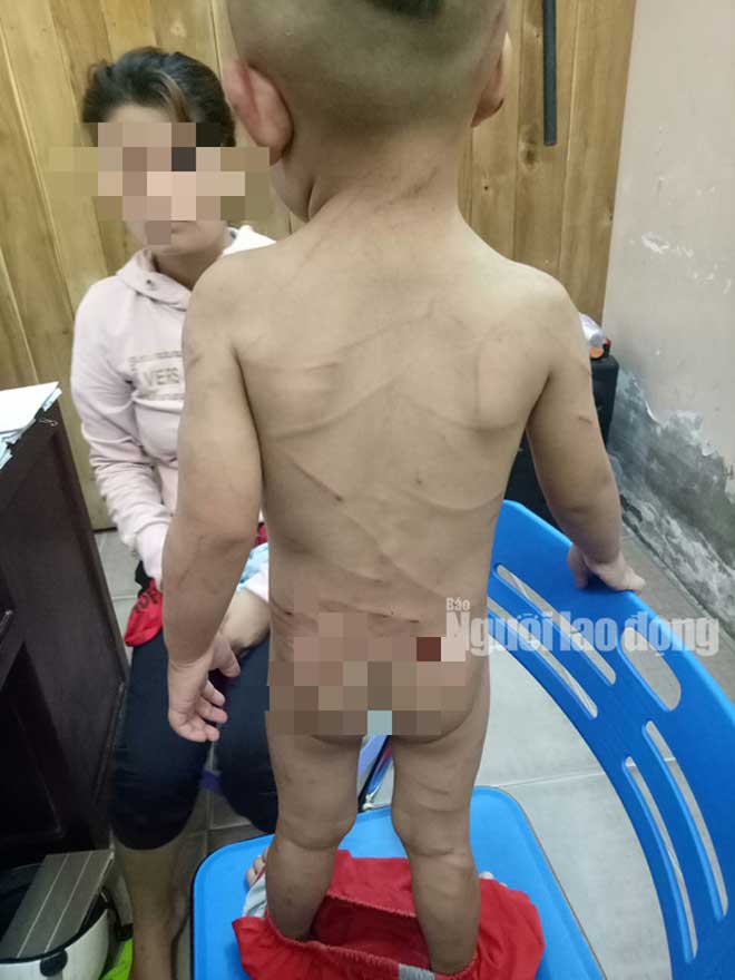 Giải cứu bé trai 3 tuổi bị cha dượng đánh dã man ở Phú Quốc - 1
