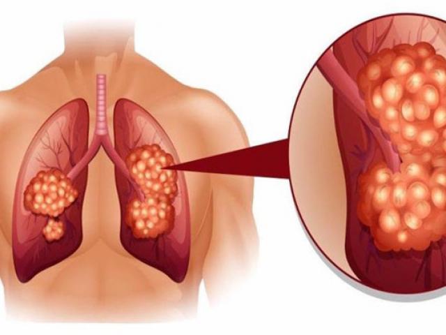 Cách phát hiện sớm căn bệnh ung thư phổi