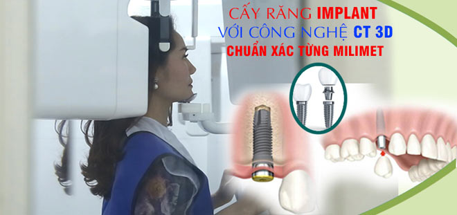 Cấy răng Implant với công nghệ CT 3D mới, chuẩn xác từng milimet - 1