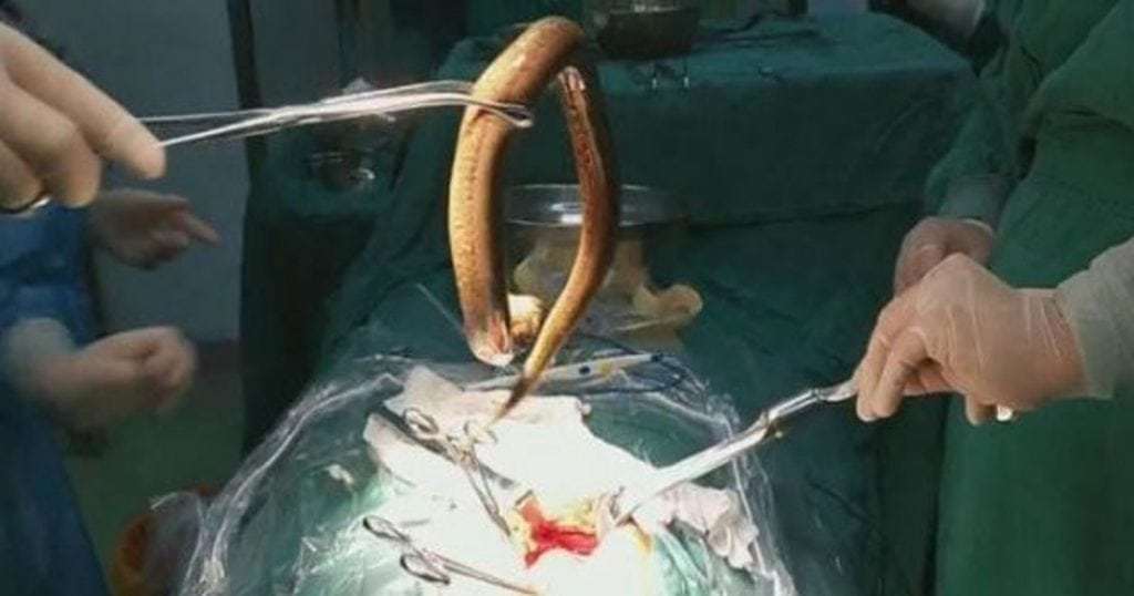Người đàn ông lĩnh hậu quả vì nuốt lươn sống dài 30cm vào bụng - 1