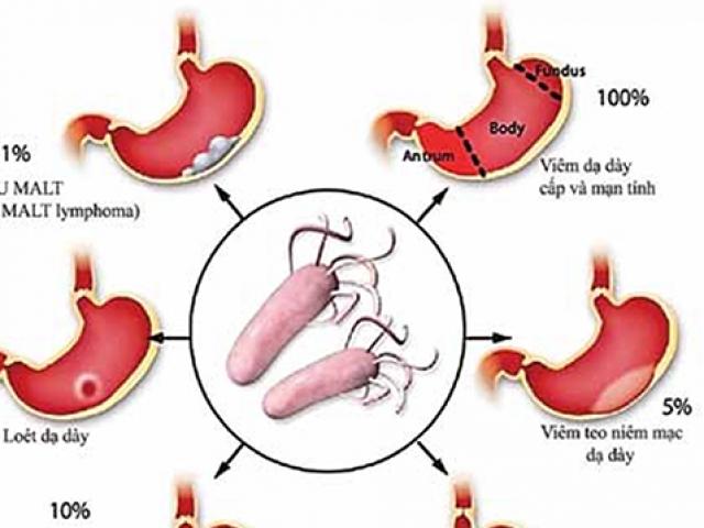 Cảnh báo nguy cơ nhiễm vi khuẩn HP có thể gây ung thư dạ dày từ nụ hôn