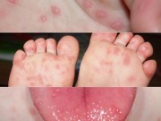 Sức khỏe đời sống - Chủng virus gây đại dịch tay chân miệng năm 2011 đã trở lại?