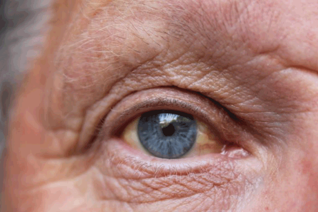 13. Vàng da có thể biểu hiện ở màu da, lòng trắng của mắt là do nồng độ cao của bilirubin trong máu của bạn. Một lá gan khỏe mạnh chuyển hóa bilirubin để giữ mức này trong máu thấp. Có nhiều nguyên nhân tiềm ẩn gây vàng da, nhưng một trong những điều đáng lo ngại nhất là đó là một trong những dấu hiệu của ung thư tuyến tụy mà bạn không nên bỏ qua .
