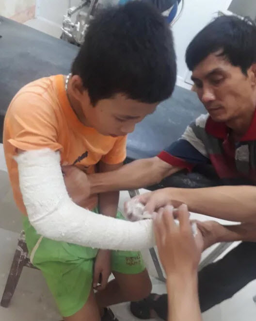 Cháu Linh bị đánh gãy tay phải bó bột Ảnh: Lương Mạnh Thắng
