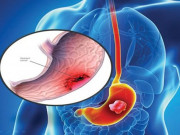 Sức khỏe đời sống - Ung thư dạ dày do thói quen ăn mặn, lười khám bệnh