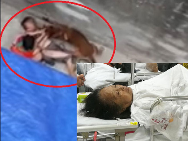 Bà Dương đang nằm điều trị tại Bệnh viện Việt Đức do bị chó nhà cháu ngoại tấn công
