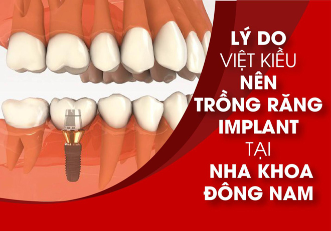 Lý do Việt Kiều nên trồng răng Implant tại Nha Khoa Đông Nam - 1