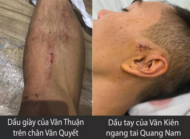 Sau khi CĐV Hà Nội FC đăng hình ảnh chân Văn Quyết bị Văn Thuận dẫm chảy máu, đến lượt ngưởi hâm mộ CLB TP HCM đáp trả với ảnh Quang Nam phải khâu mang tai sau pha vung tay rất kín của Văn Kiên