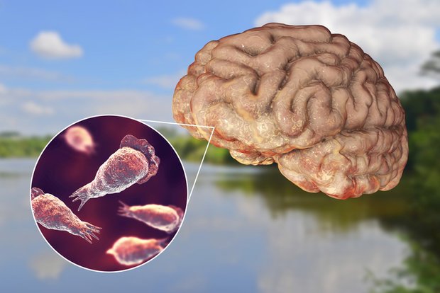 Vi khuẩn ăn não khiến người đàn ông Mỹ tử vong.