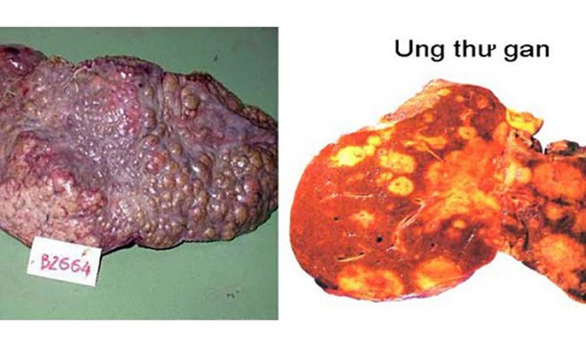 Hình ảnh gan bị các khối u xâm lấn