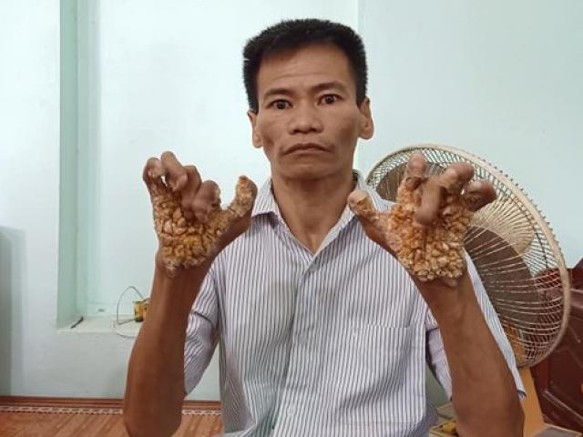 ”Người cây” đầu tiên ở Việt Nam được phát hiện sau 40 năm mang bệnh