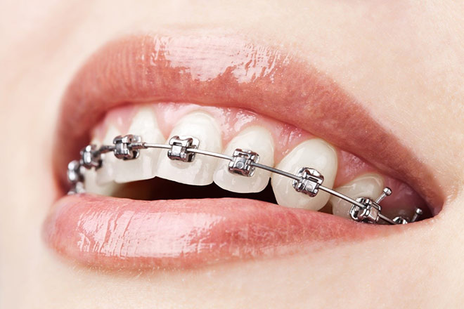 Niềng răng là một giải pháp nha khoa tuyệt vời nếu thực hiện đúng kỹ thuật