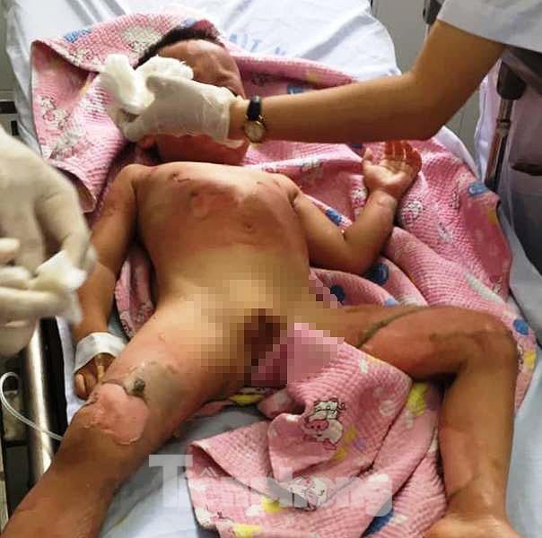 Một cháu bé bị bỏng nặng. Ảnh: Tiền Phong