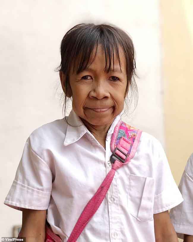 Bé gái 10 tuổi có gương mặt nhăn nheo như bà lão 60 vì mắc bệnh lạ - 1